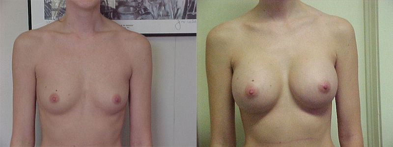 Breast Augmentation 0053