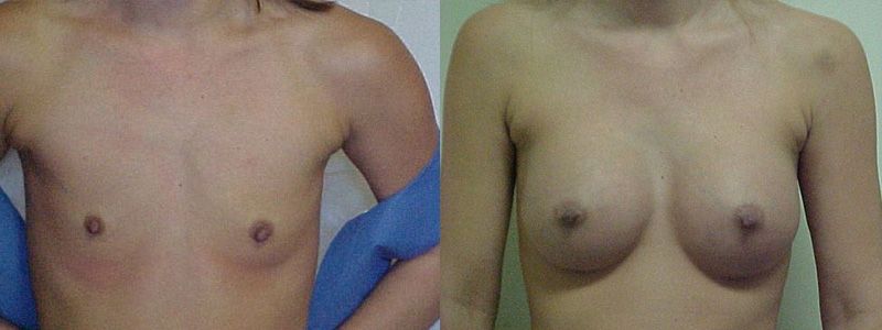 Breast Augmentation 0345