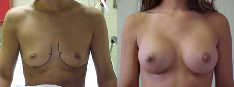 Breast Augmentation 1411
