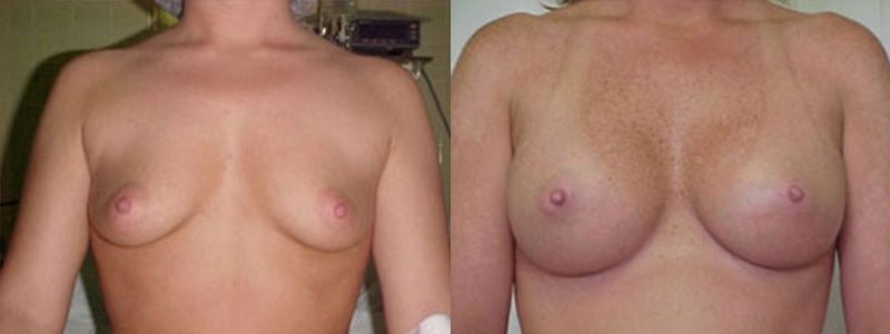 Breast Augmentation 1510