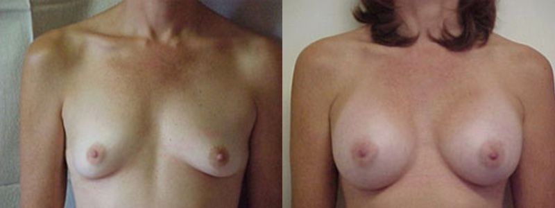 Breast Augmentation 1608