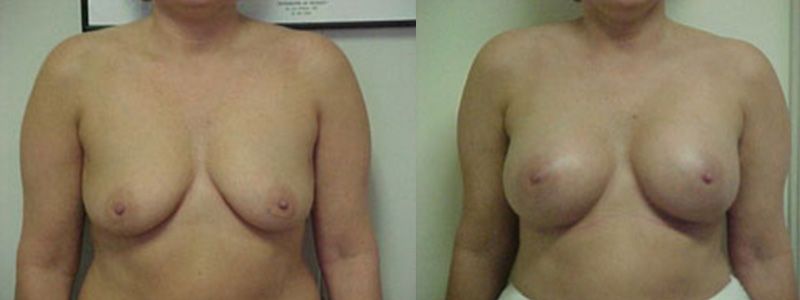 Breast Augmentation 2301