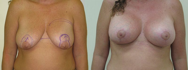 Breast Lift 1