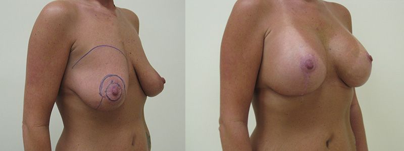 Breast Lift 2.2