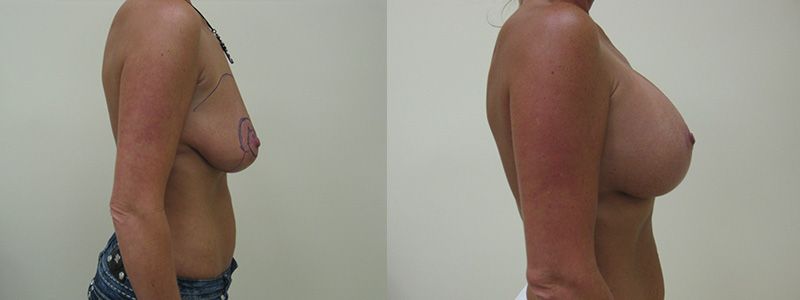 Breast Lift 2.3