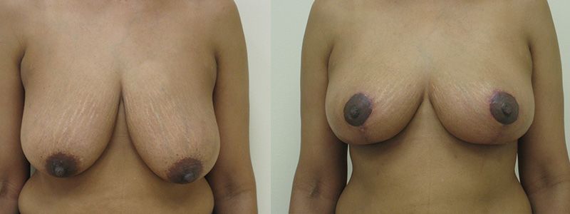 Breast Reduction 3.0