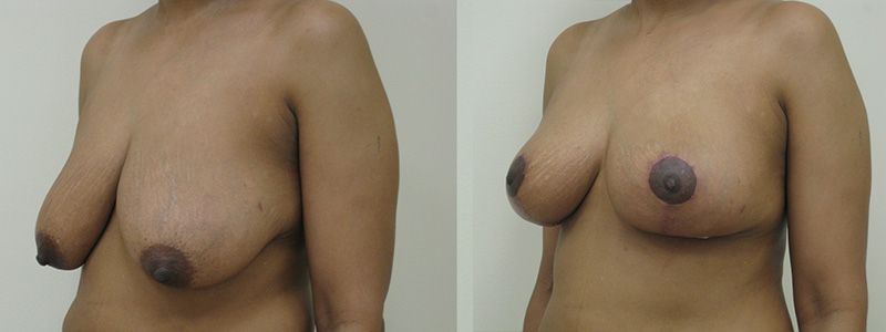 Breast Reduction 3.2