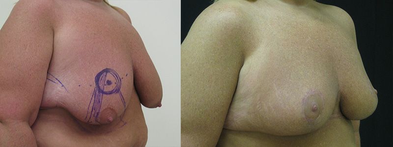 Breast Reduction 4.2