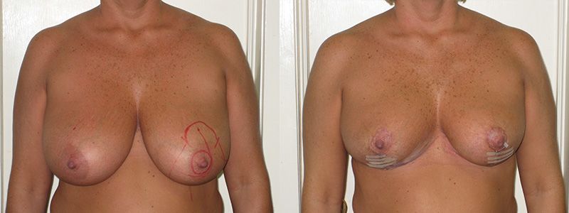 Breast Reduction 5