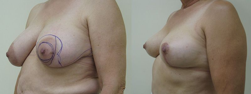 Breast Reduction 6.2