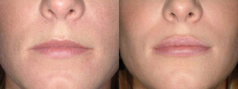 Lip Augmentation 01