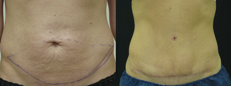 Tummy Tuck 04